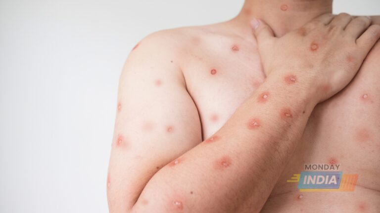 WHO Declares Mpox a Global Health Emergency: Key Information You Should Know